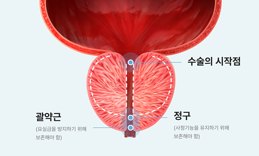 전립선 수술 전 절제 범위 설정 단계