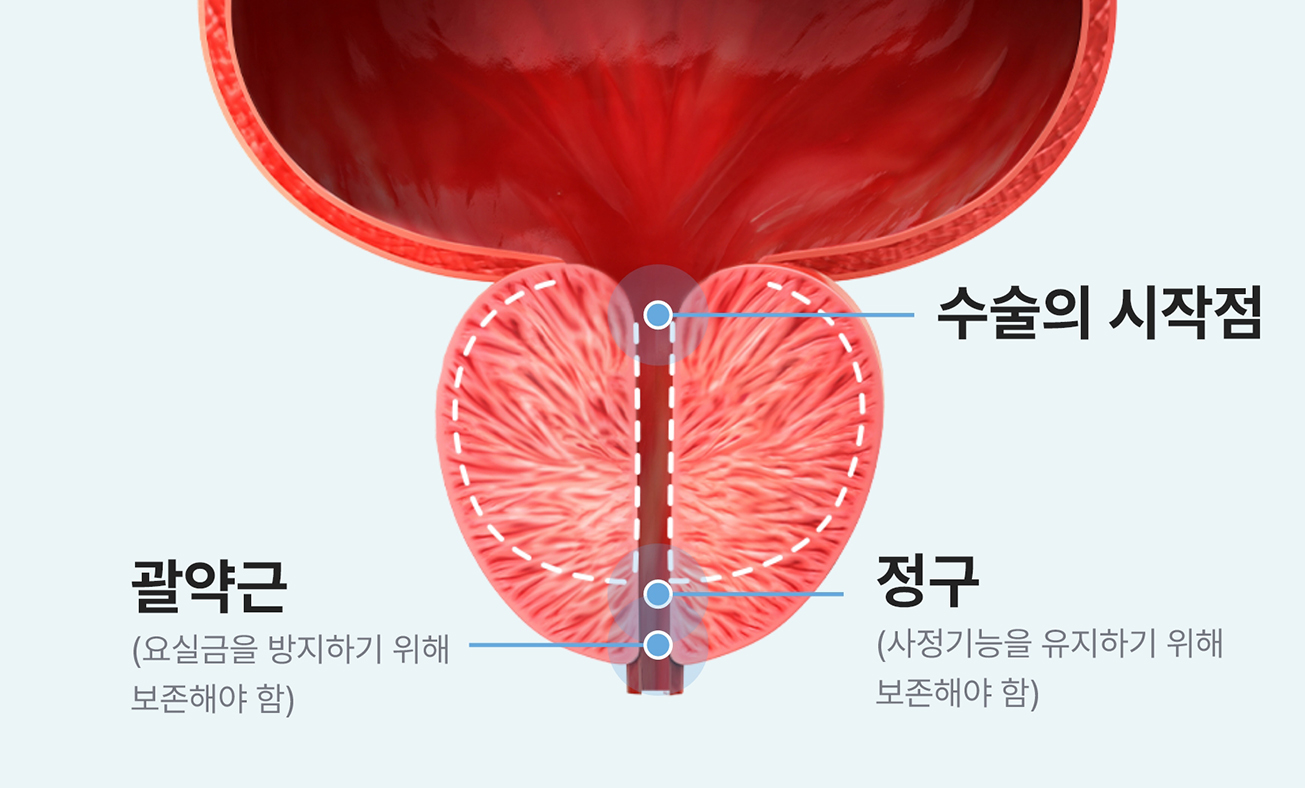 전립선 수술 전 절제 범위 설정 단계