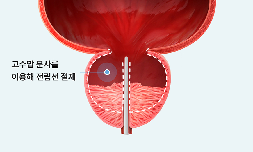 워터젯으로 전립선 조직을 절제하는 과정