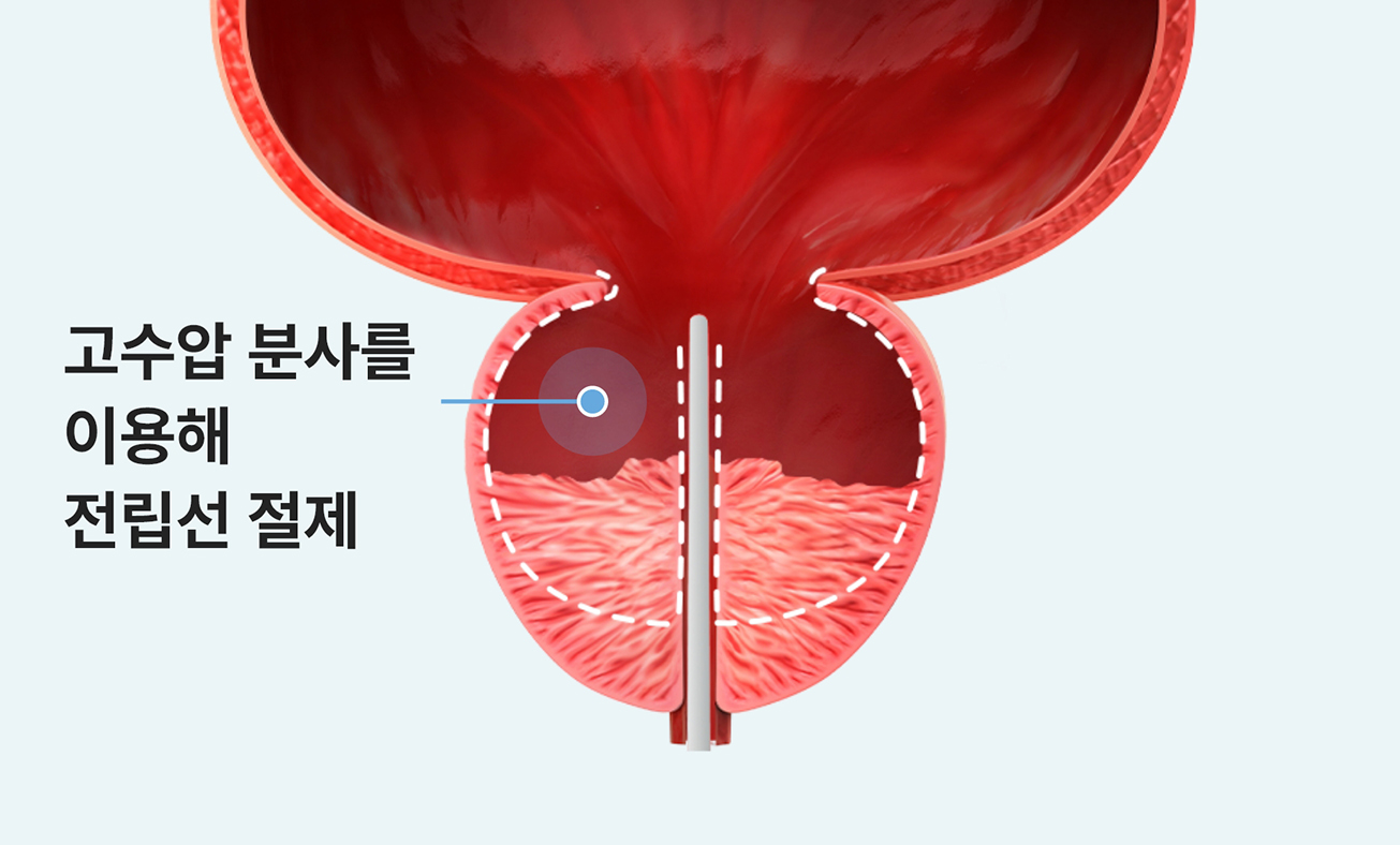 워터젯으로 전립선 조직을 절제하는 과정