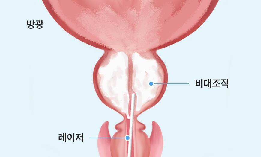 홀렙 수술에서 레이저로 전립선 비대 조직을 절개하는 단계 이미지