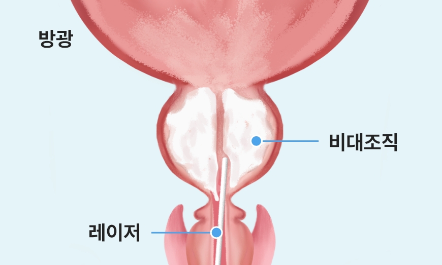 홀렙 수술에서 레이저로 전립선 비대 조직을 절개하는 단계 이미지