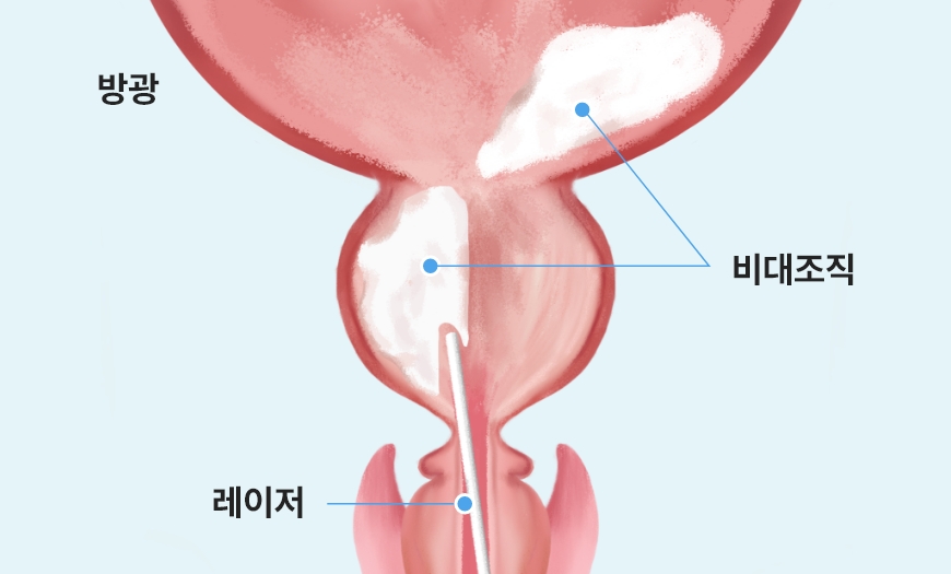 레이저로 절개된 전립선 조직을 방광으로 이동시키는 과정 이미지