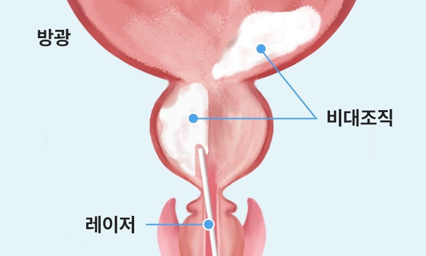 레이저로 절개된 전립선 조직을 방광으로 이동시키는 과정 이미지