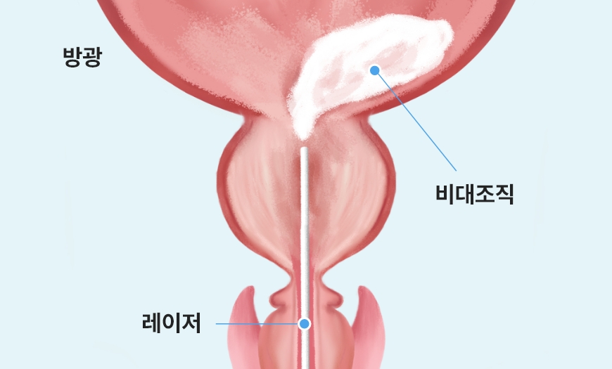 분쇄기를 이용해 전립선 조직을 제거하는 홀렙 수술 마무리 단계 이미지