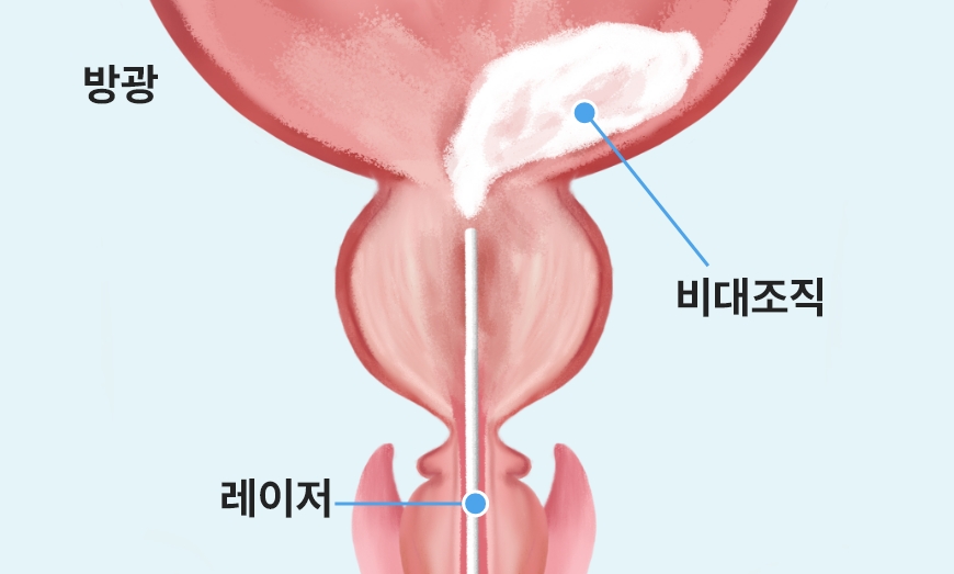 분쇄기를 이용해 전립선 조직을 제거하는 홀렙 수술 마무리 단계 이미지