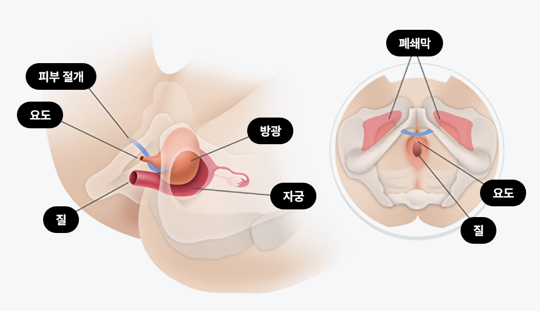 1DAY 요실금 수술 이미지, TOT 수술 Trans Obturator Tape 방식으로 여성 요실금 치료 시 요도와 방광을 지지하는 슬링 삽입 구조를 설명하는 의료 도식