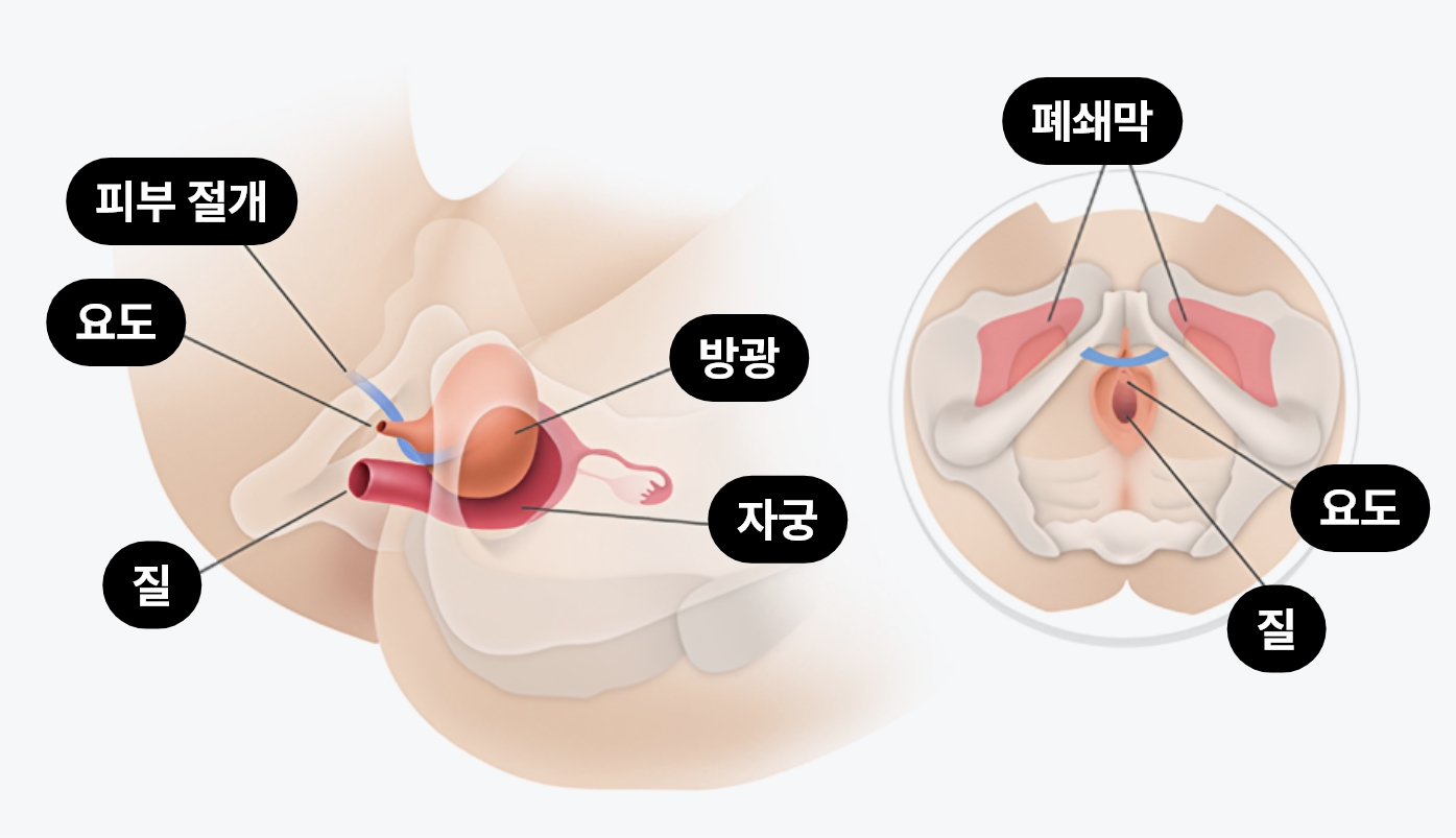 1DAY 요실금 수술 이미지, TOT 수술 Trans Obturator Tape 방식으로 여성 요실금 치료 시 요도와 방광을 지지하는 슬링 삽입 구조를 설명하는 의료 도식