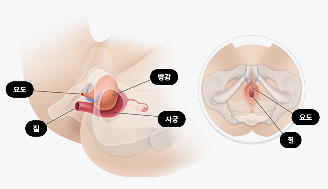 미니슬링 요실금 수술 이미지, 여성 요도 지지용 미니슬링 삽입으로 피부 절개 없이 요실금을 치료하는 1DAY 수술 구조 설명 도식