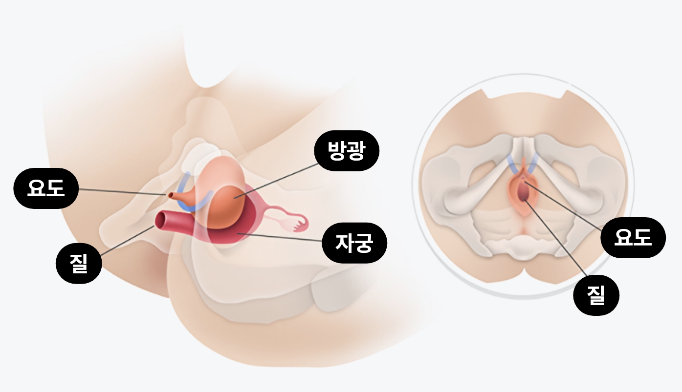 미니슬링 요실금 수술 이미지, 여성 요도 지지용 미니슬링 삽입으로 피부 절개 없이 요실금을 치료하는 1DAY 수술 구조 설명 도식