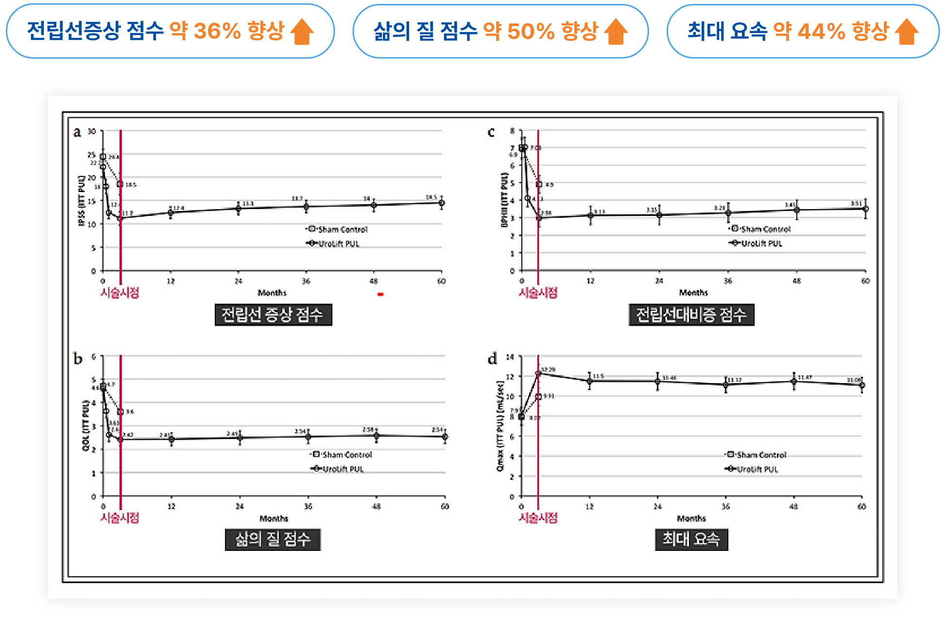 전립선비대증 치료 후 5년간 전립선 증상 점수와 삶의 질, 요속 변화 지표를 보여주는 논문 기반 그래프 이미지