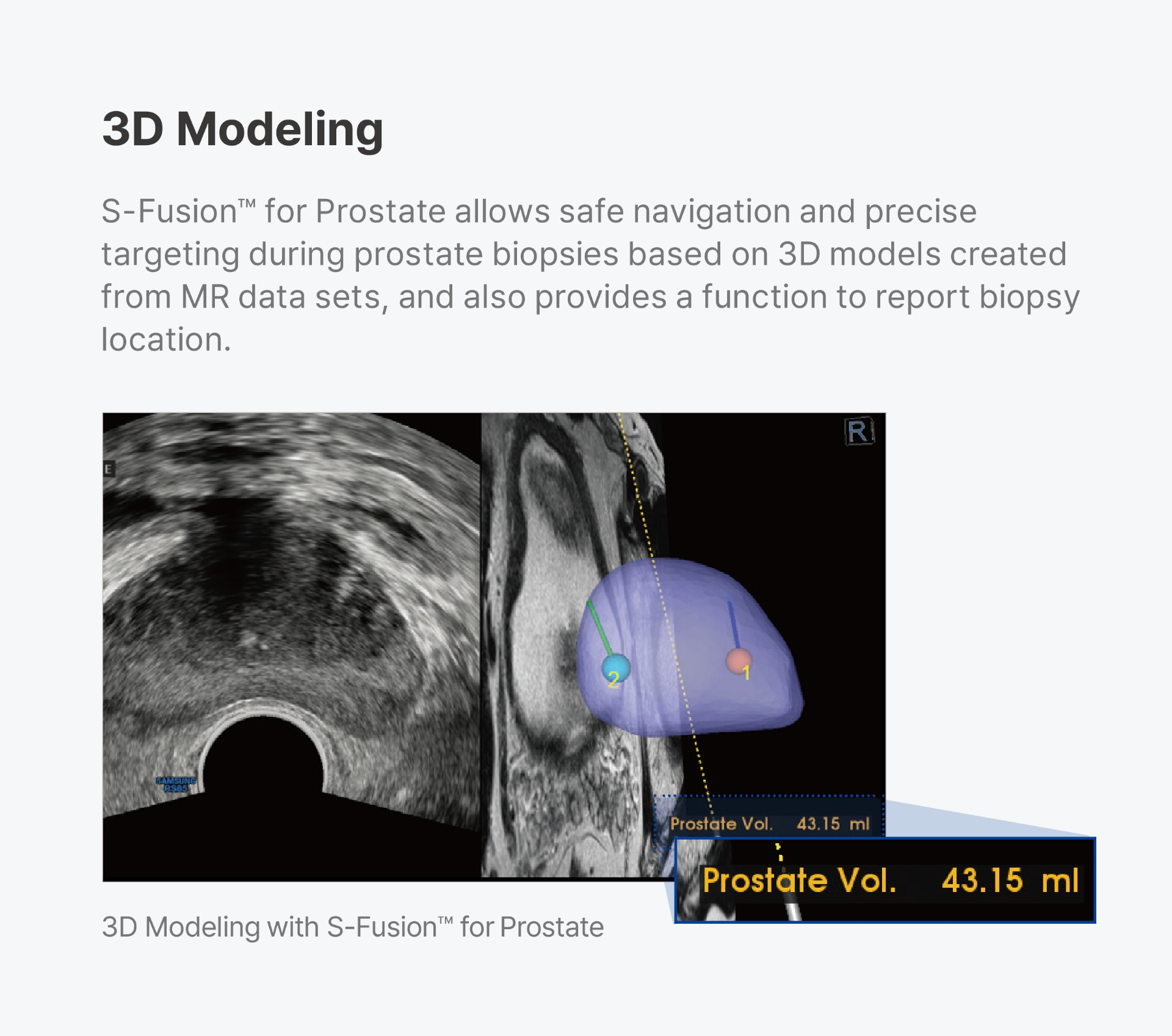 전립선 구조를 3D로 구현해 표적 조직검사를 수행하는 MRI 융합 모델링 이미지