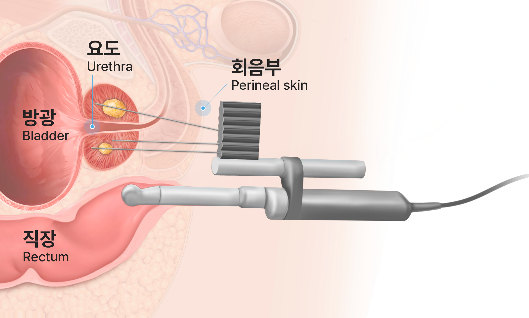 전립선 조직검사 경회음부 접근법, 회음부를 통해 바늘을 삽입해 전립선 특정 부위를 정밀 검사하는 방식