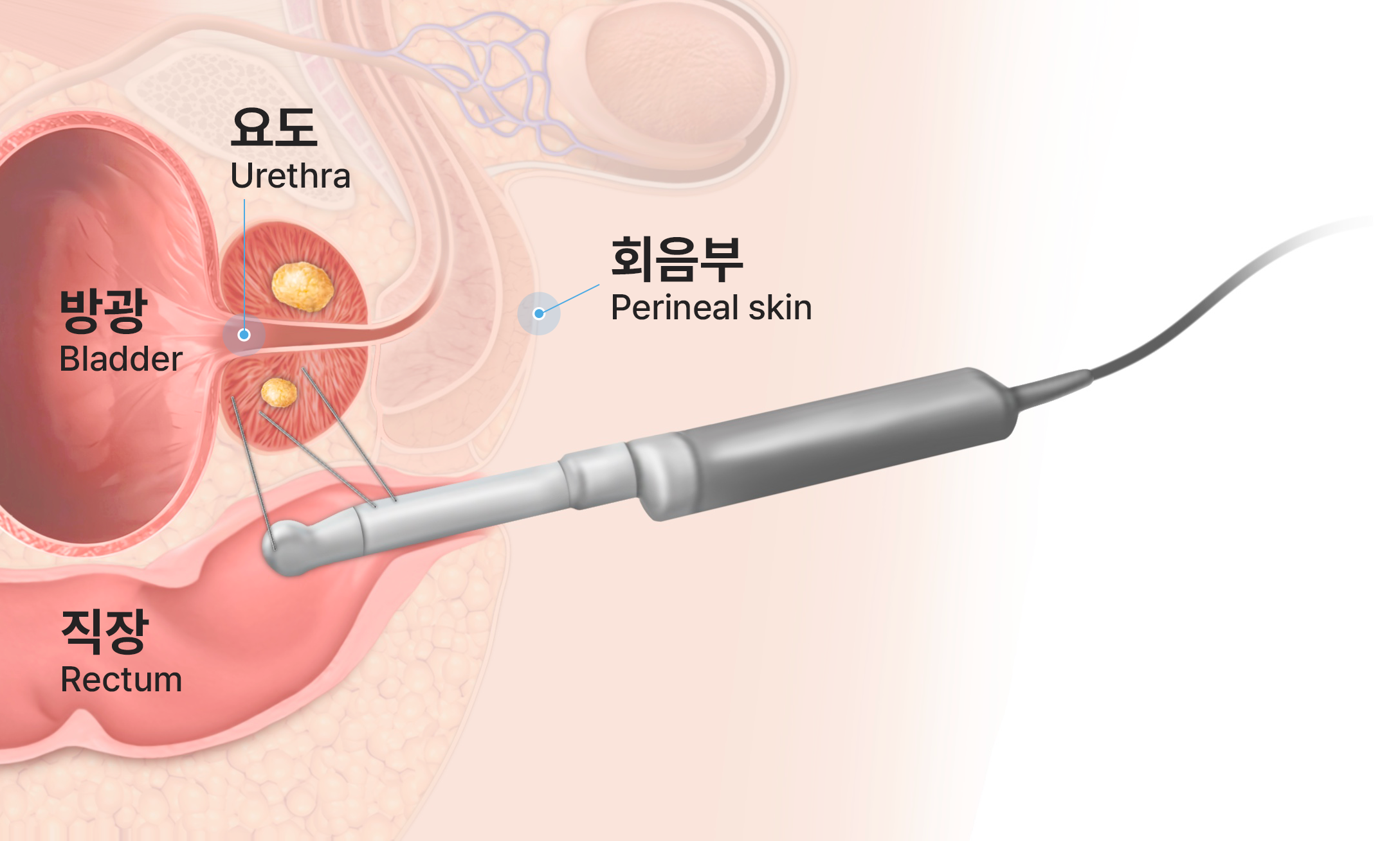 전립선 조직검사 경직장 접근법, 직장을 통해 초음파 프로브를 삽입해 전립선을 검사하는 방식