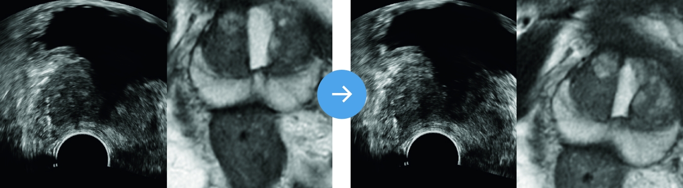 MRI 초음파 융합 조직검사 자동 보정 기술, 검사 중 실시간 영상 정합을 통해 전립선 위치 오차를 줄이는 시스템