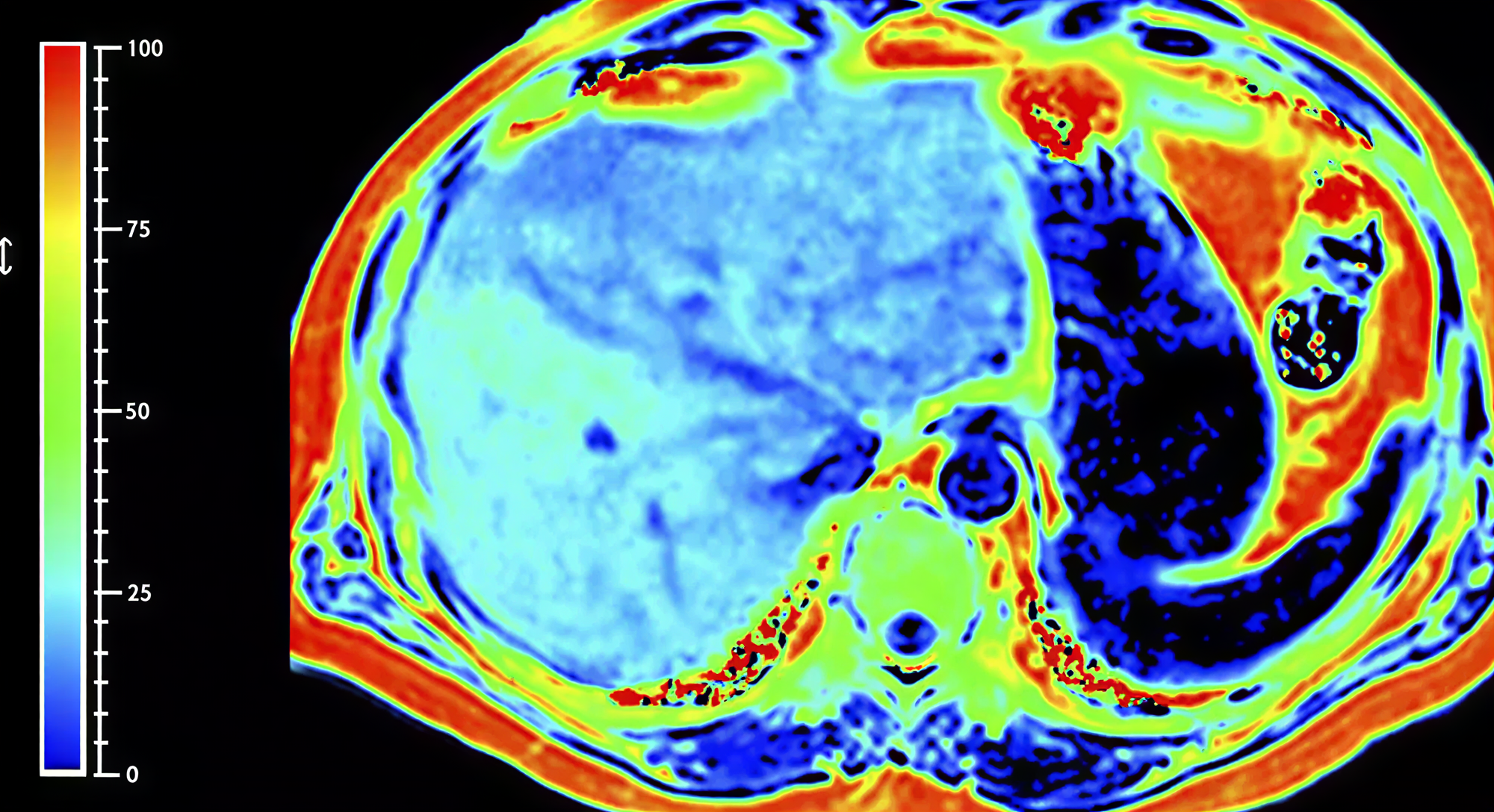 전립선암 고위험 병변을 분석하는 다중파라미터 MRI 영상 이미지, 암 위치와 위험도 평가