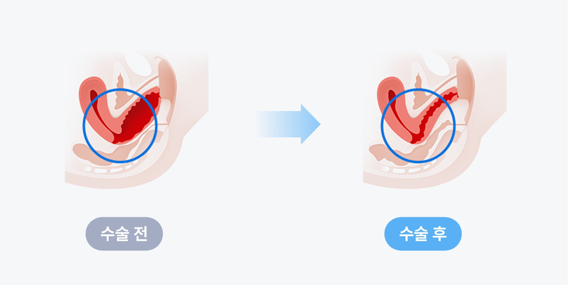 질성형 수술 전후 비교 이미지, 질이완 개선과 질축소 및 질수축력 회복을 설명하는 여성질성형 수술 전후 변화도