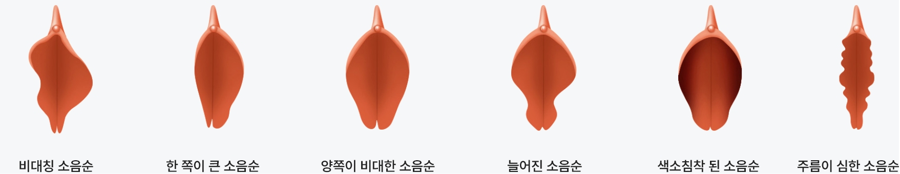 다양한 소음순 모양 비교 이미지, 비대칭 소음순 한쪽 비대 소음순 양측 비대 소음순 늘어진 소음순 색소침착 소음순 주름형 소음순 등 여성 소음순 형태를 설명하는 도식