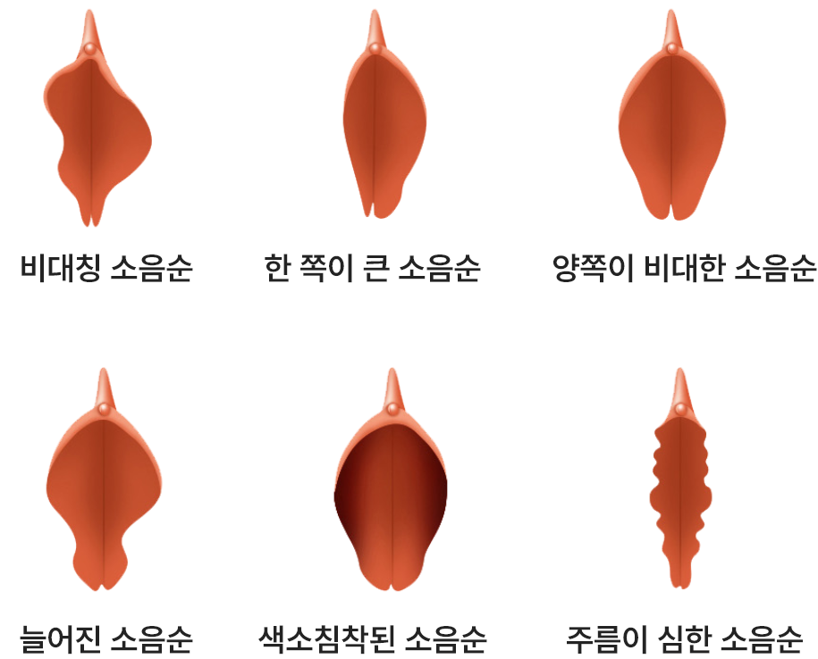 다양한 소음순 모양 비교 이미지, 비대칭 소음순 한쪽 비대 소음순 양측 비대 소음순 늘어진 소음순 색소침착 소음순 주름형 소음순 등 여성 소음순 형태를 설명하는 도식