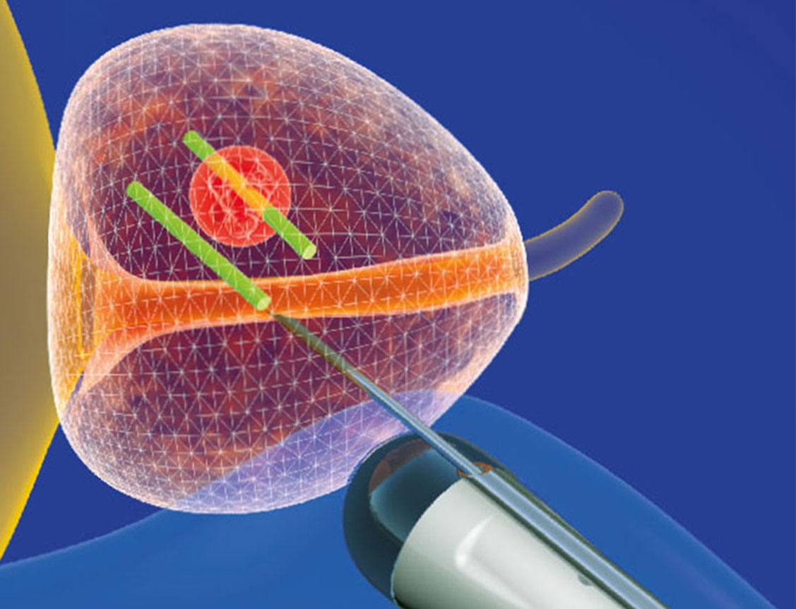 전립선 정밀 검사 및 판독 시스템 - MRI Fusion Target Bx 등 검사 리드타임을 최소화한 의사결정 프로세스