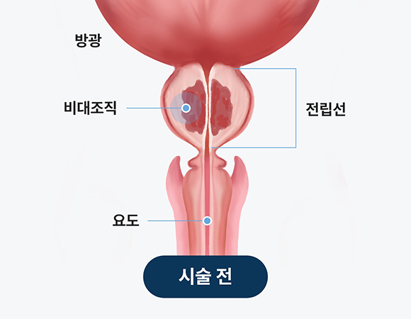 전립선비대증 리줌 시술 전 전립선 비대 상태를 보여주는 구조 이미지