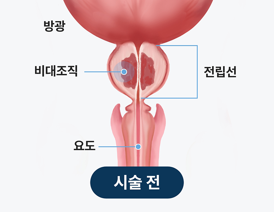 전립선비대증 리줌 시술 전 전립선 비대 상태를 보여주는 구조 이미지