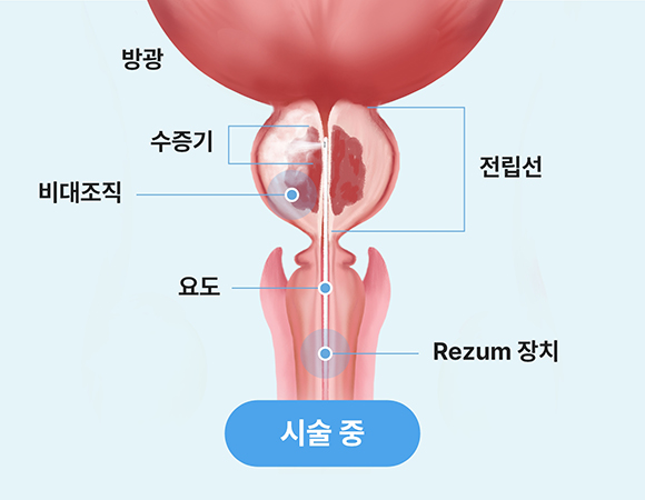 리줌 시술 중 수증기를 주입해 전립선 조직을 치료하는 과정 이미지