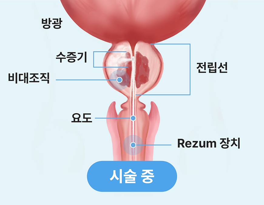 리줌 시술 중 수증기를 주입해 전립선 조직을 치료하는 과정 이미지