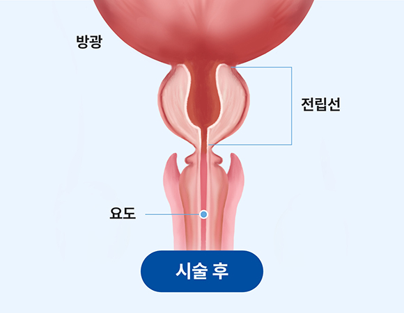 리줌 시술 후 전립선 압박이 완화된 상태를 보여주는 이미지