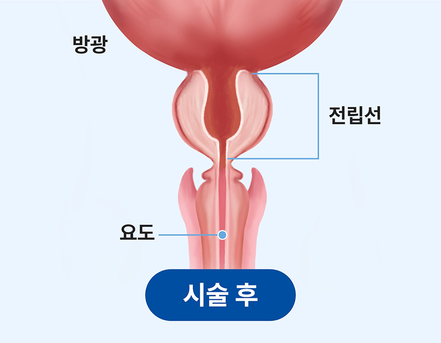 리줌 시술 후 전립선 압박이 완화된 상태를 보여주는 이미지