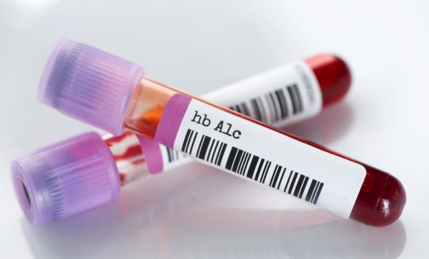 혈액검사 이미지, 성매개성 질환 혈액검사로 HIV 에이즈·매독·간염 등 감염 여부를 확인하는 정밀 검사