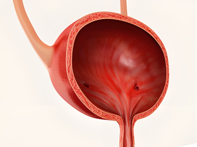 방광염 이미지, 하부 요로감염으로 방광 점막에 염증이 발생한 상태를 설명하는 여성·남성 방광염 질환 이미지