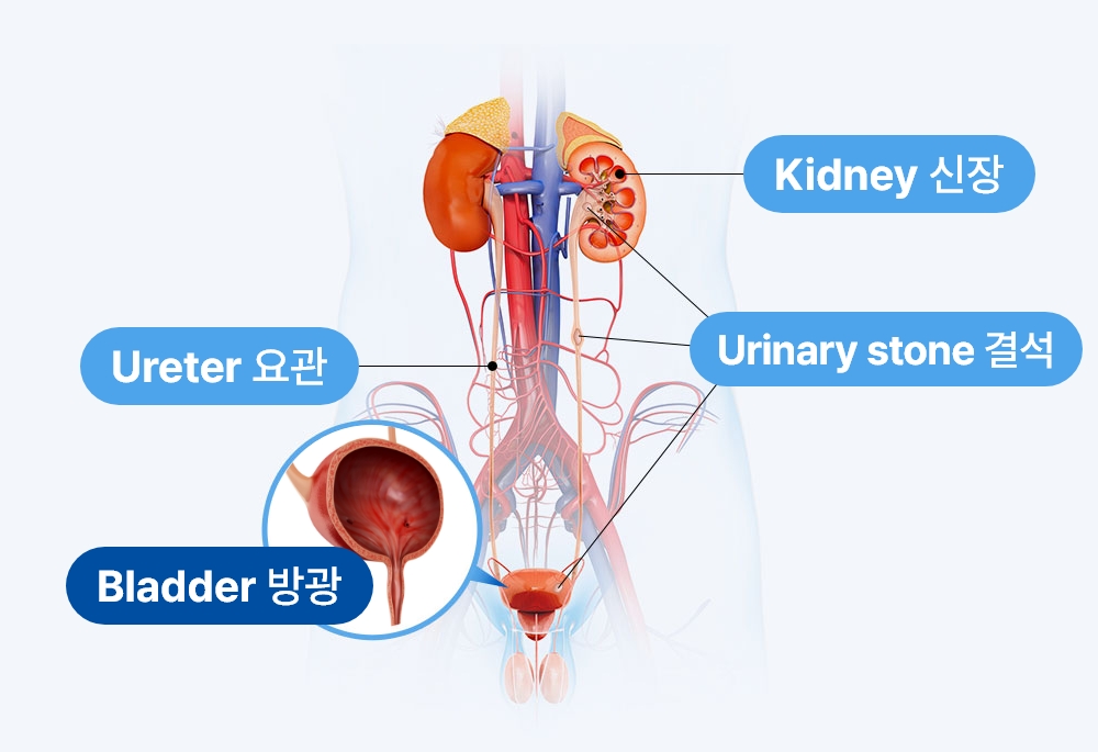 요로결석의 종류와 위치를 보여주는 인체 구조 이미지, 신장 요관 방광 요도 결석 설명