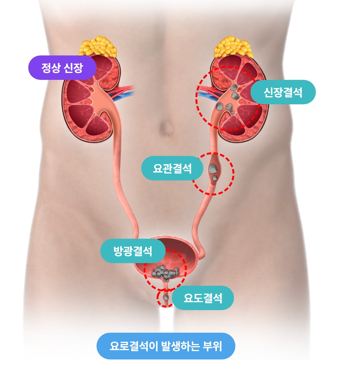 요로결석이 발생하는 부위 설명 이미지, 신장 요관 방광 요도 결석 위치 안내