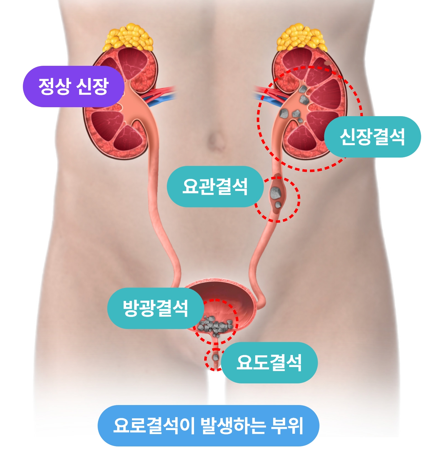 요로결석이 발생하는 부위 설명 이미지, 신장 요관 방광 요도 결석 위치 안내