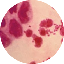 임균 이미지, STD PCR 검사로 임질을 일으키는 Neisseria gonorrhoeae 감염 여부를 확인하는 성매개성 질환 검사