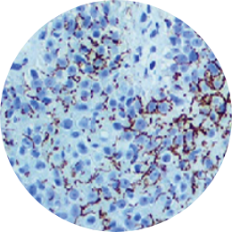 매독균 이미지, STD PCR 검사로 Treponema pallidum 매독 감염 여부를 확인하는 성매개성 질환 검사