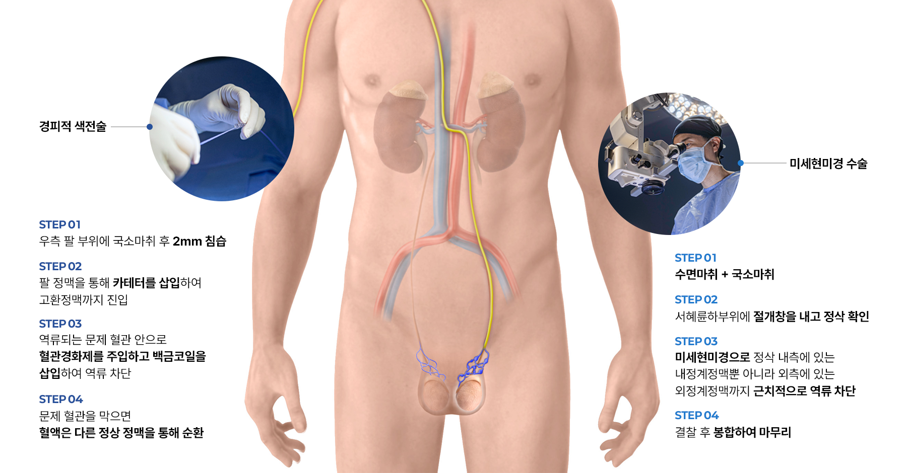 정계정맥류 치료 비교 통이미지, 경피적 색전술과 미세현미경 수술의 시술 과정 및 고환 정맥 구조를 함께 설명하는 남성난임 치료 의료 도식