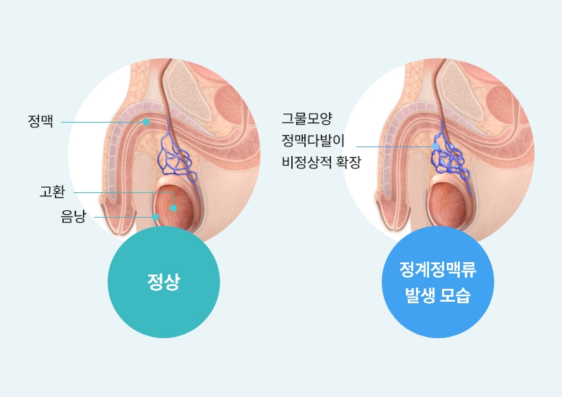 정계정맥류 비교 이미지, 정상 고환 정맥 구조와 정계정맥류 발생 시 정맥 확장 및 혈관 이상을 비교한 남성난임 의료 도식