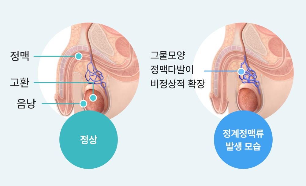 정계정맥류 비교 이미지, 정상 고환 정맥 구조와 정계정맥류 발생 시 정맥 확장 및 혈관 이상을 비교한 남성난임 의료 도식