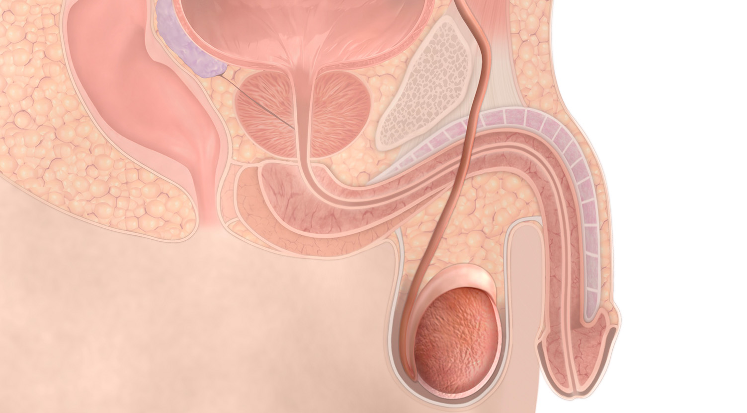 무도정관수술 의료 이미지, 정관을 차단해 영구 피임을 시행하는 남성 정관수술 구조와 원리 안내